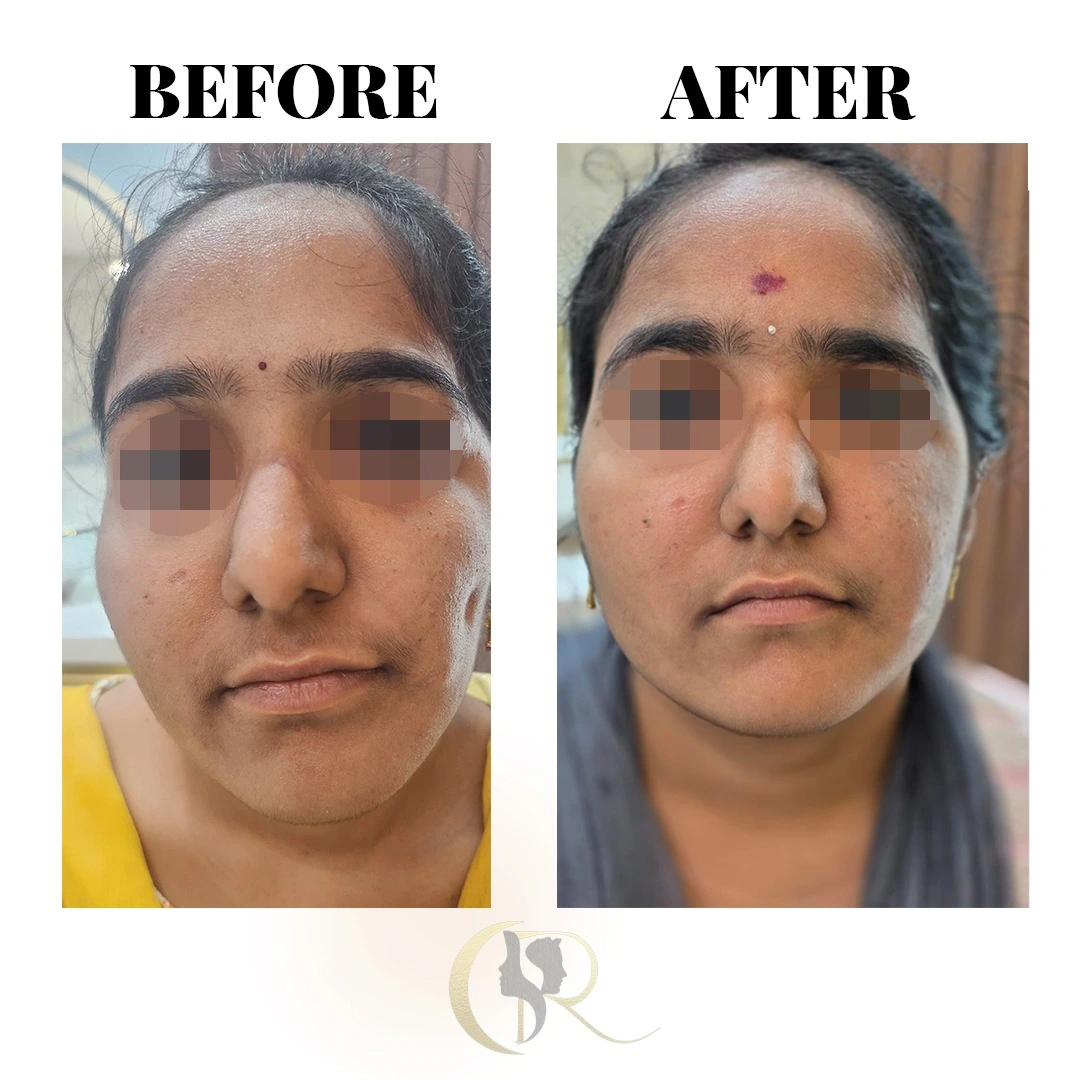 Frontal facial symmetry restoration using fat grafting with Vaser Technology for Hemifacial Microsomia at Cosmo Radiance Hyderabad India Frontal facial symmetry restoration using fat grafting with Vaser Technology for Hemifacial Microsomia at Cosmo Radiance Hyderabad India