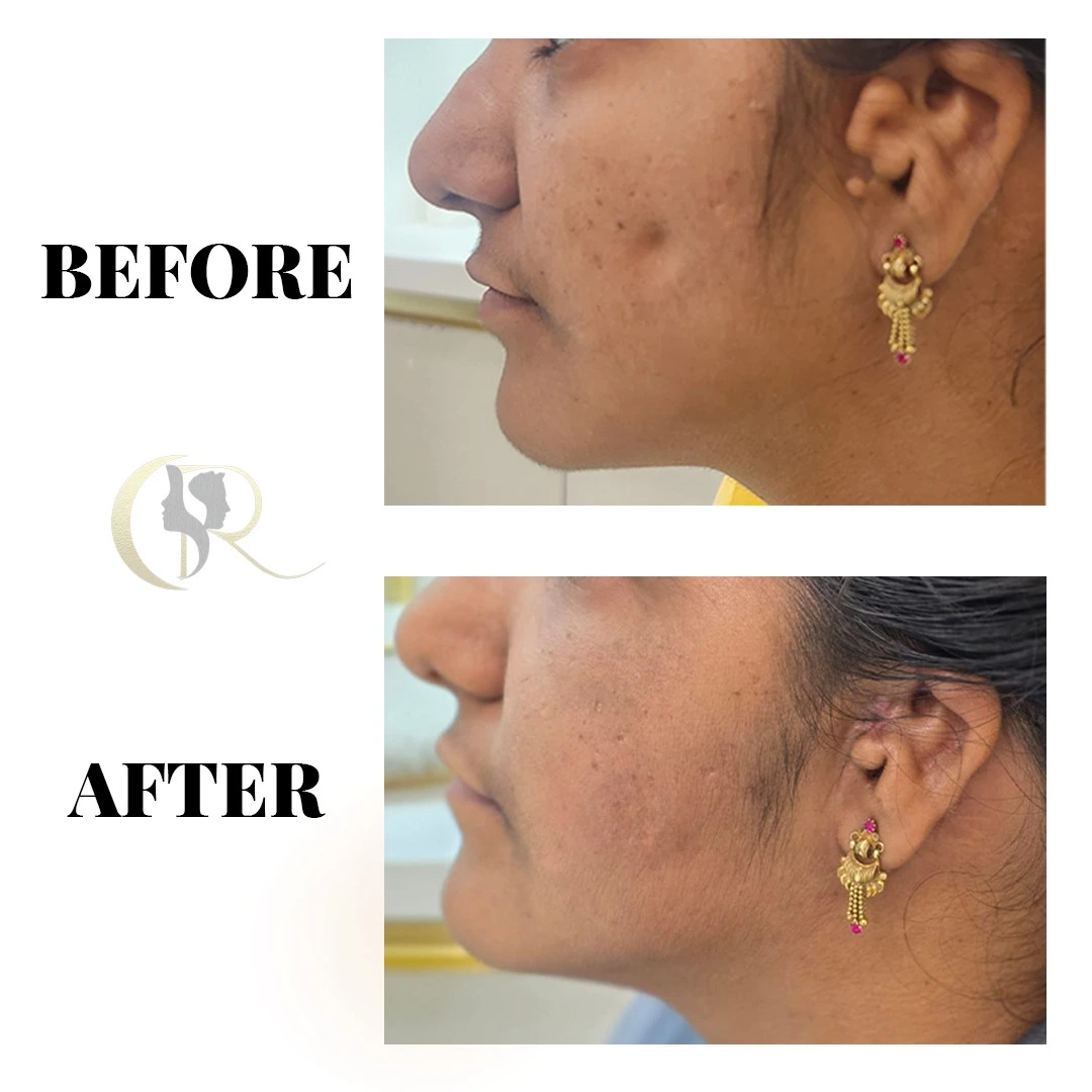Facial symmetry correction using fat grafting with Vaser Technology for Hemifacial Microsomia side profile result at Cosmo Radiance Hyderabad India Facial symmetry correction using fat grafting with Vaser Technology for Hemifacial Microsomia side profile result at Cosmo Radiance Hyderabad India
