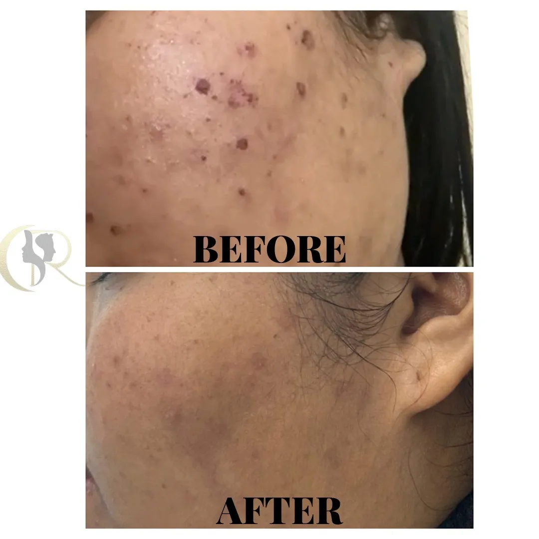 Male acne scar removal using Fotona Starwalker MAQX and Candela CO2RE laser treatment result after 5 sessions in 3 months at Cosmo Radiance Hyderabad India Male acne scar removal using Fotona Starwalker MAQX and Candela CO2RE laser treatment result after 5 sessions in 3 months at Cosmo Radiance Hyderabad India