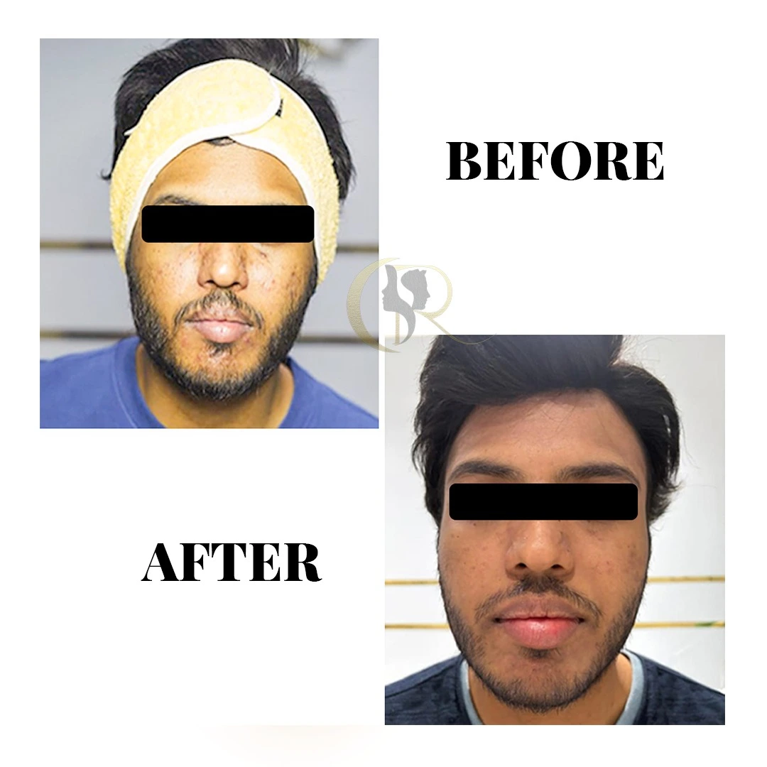 Acne scar treatment result 3 months post-procedure using MNRF Scarlet S, Fotona Starwalker, Subcision, and Candela CO2RE at Cosmo Radiance Hyderabad India Acne scar treatment result 3 months post-procedure using MNRF Scarlet S, Fotona Starwalker, Subcision, and Candela CO2RE at Cosmo Radiance Hyderabad India