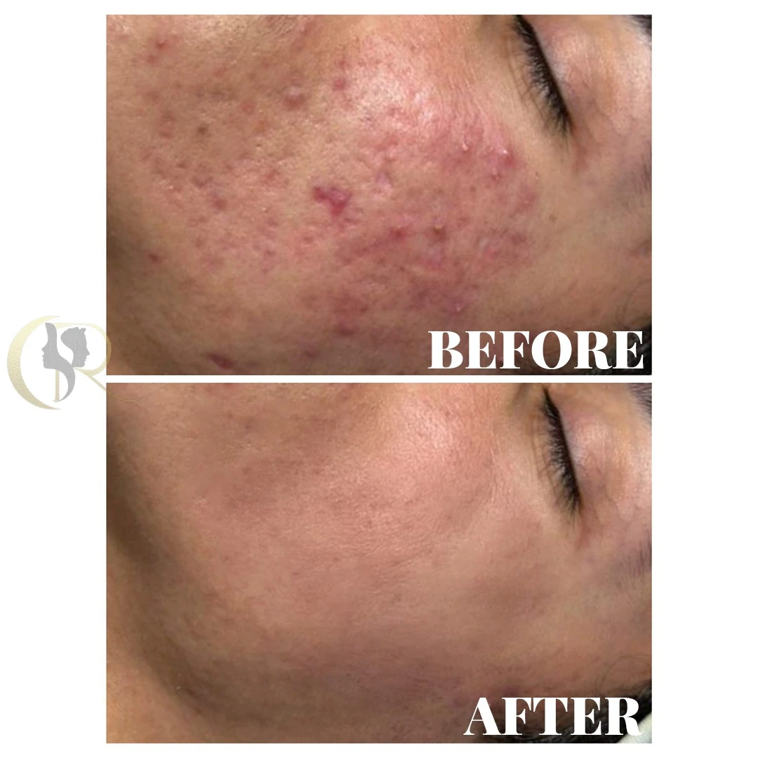 Male acne scar treatment using Scarlet S MNRF and Fotona Starwalker MAQX laser skin toning result after 5 sessions in 3 months at Cosmo Radiance Hyderabad India Male acne scar treatment using Scarlet S MNRF and Fotona Starwalker MAQX laser skin toning result after 5 sessions in 3 months at Cosmo Radiance Hyderabad India