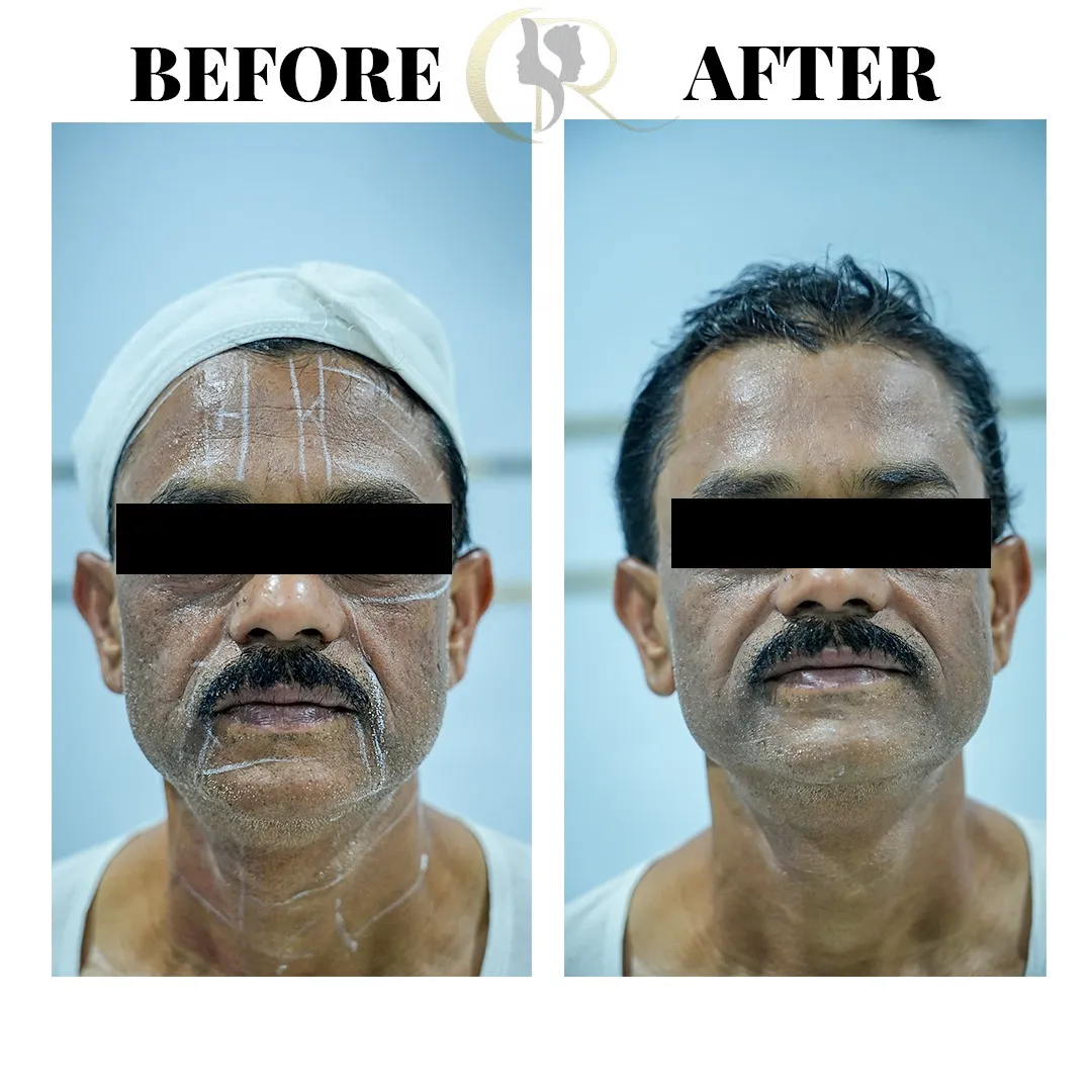 Male anti-aging robotic face lift before and after result using Ultraformer MPT showing skin tightening at Cosmo Radiance Hyderabad India Male anti-aging robotic face lift before and after result using Ultraformer MPT showing skin tightening at Cosmo Radiance Hyderabad India