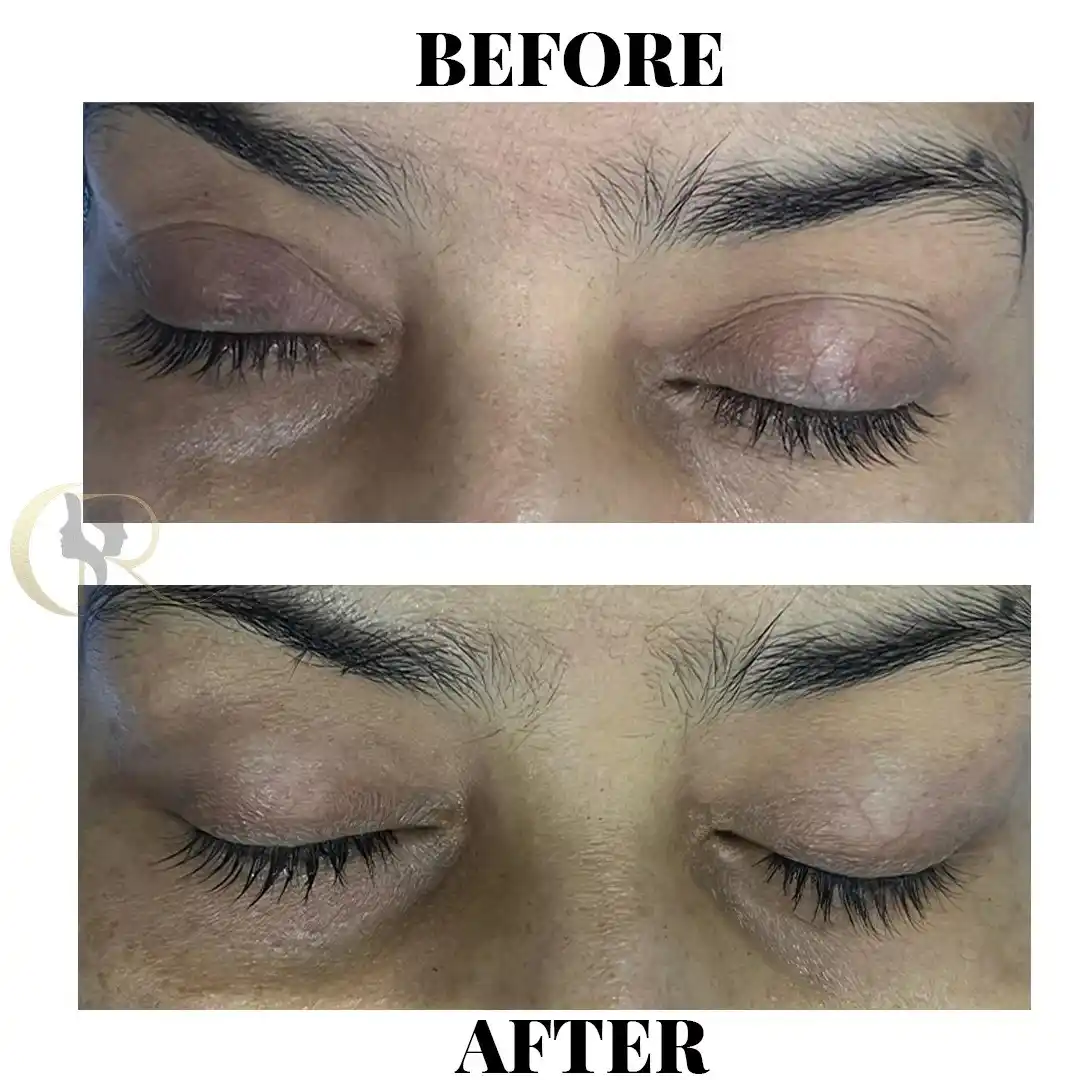 Deep Plane Facelift vs. Mini Facelift: Why Repositioning SMAS Beats Skin-Only Lifts
