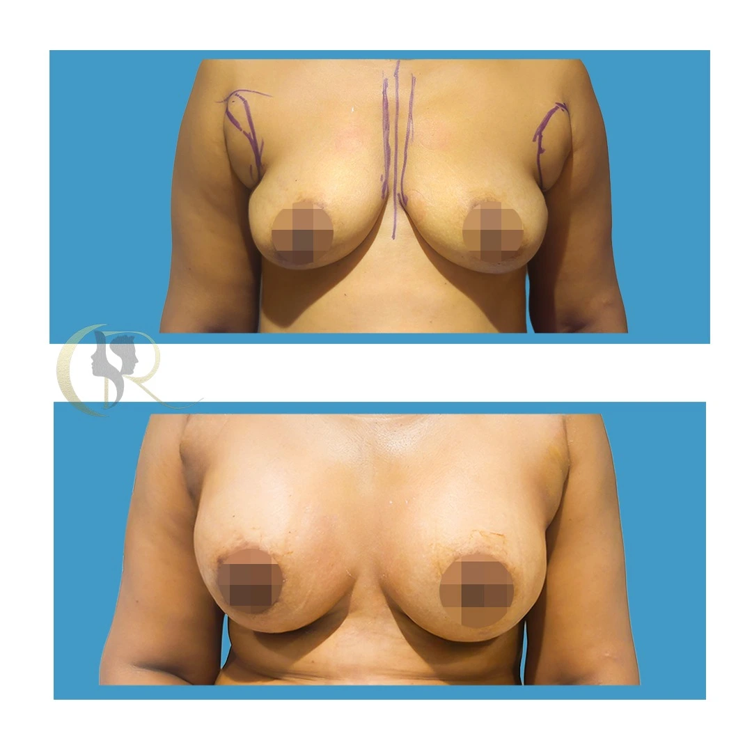 Breast augmentation with Motiva implants showing post-surgery Day 10 result using Vectra H2 Body Imaging at Cosmo Radiance Hyderabad India Breast augmentation with Motiva implants showing post-surgery Day 10 result using Vectra H2 Body Imaging at Cosmo Radiance Hyderabad India