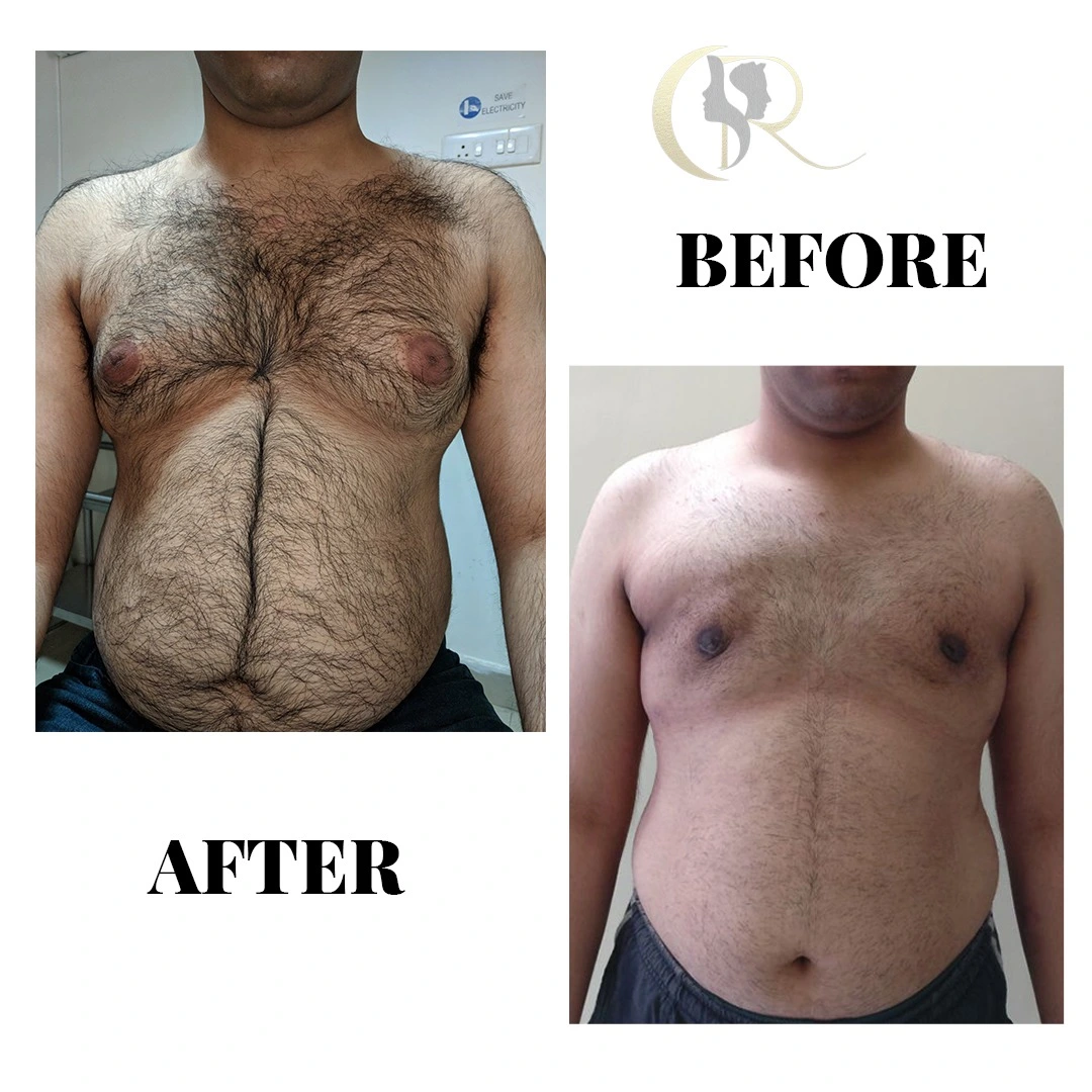 Male chest contouring and gland excision using Vaser 2.0 Ventx console and Vaser Smooth at Cosmo Radiance Hyderabad India Male chest contouring and gland excision using Vaser 2.0 Ventx console and Vaser Smooth at Cosmo Radiance Hyderabad India