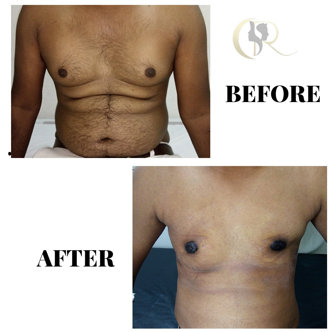 Gynecomastia surgery result showing male chest contouring on Day 5 post Vaser 2.0 Ventx Vaser Smooth procedure at Cosmo Radiance Hyderabad India Gynecomastia surgery result showing male chest contouring on Day 5 post Vaser 2.0 Ventx Vaser Smooth procedure at Cosmo Radiance Hyderabad India