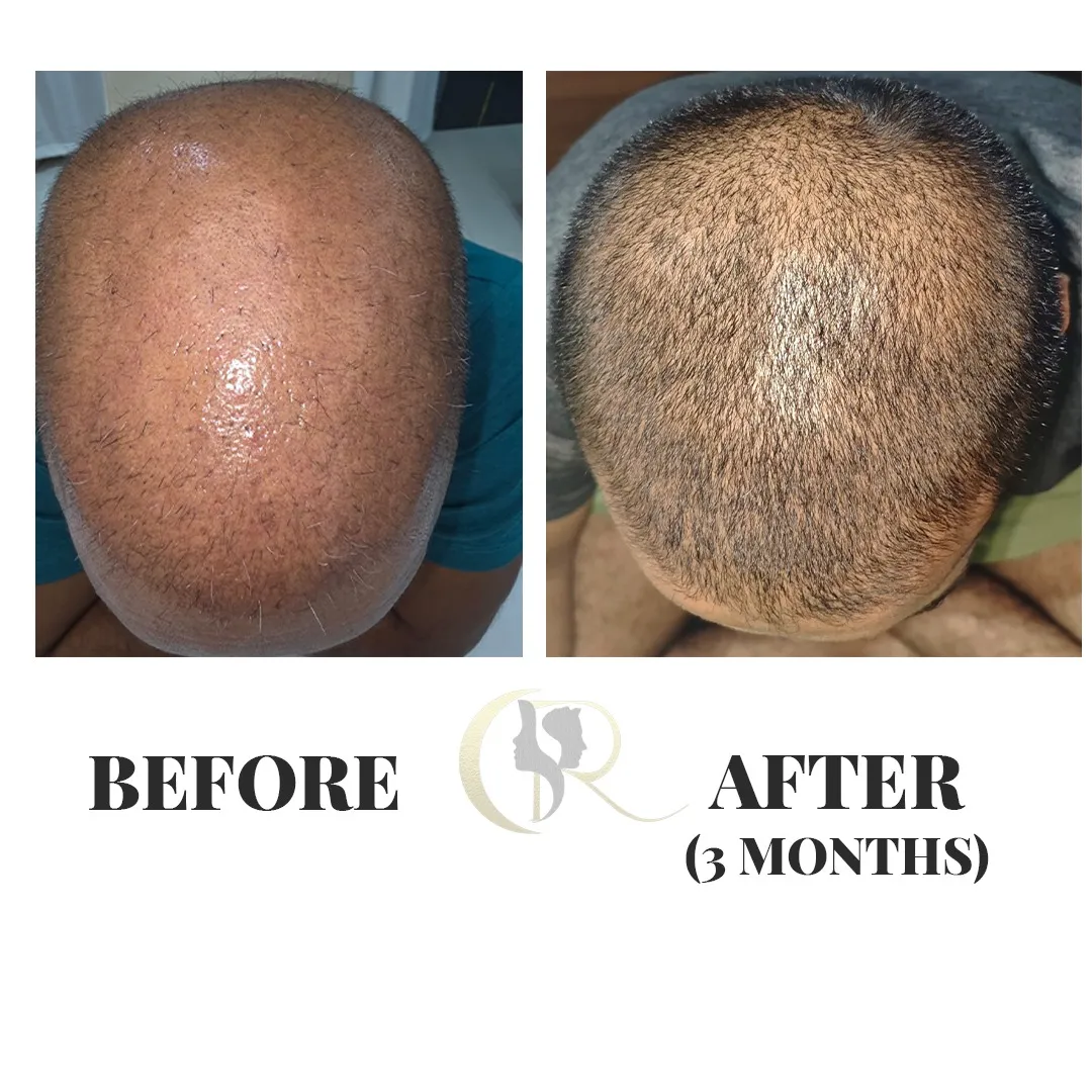 Crown area hair transplant growth showing density improvement after 3 months at Cosmo Radiance Hyderabad India Crown area hair transplant growth showing density improvement after 3 months at Cosmo Radiance Hyderabad India