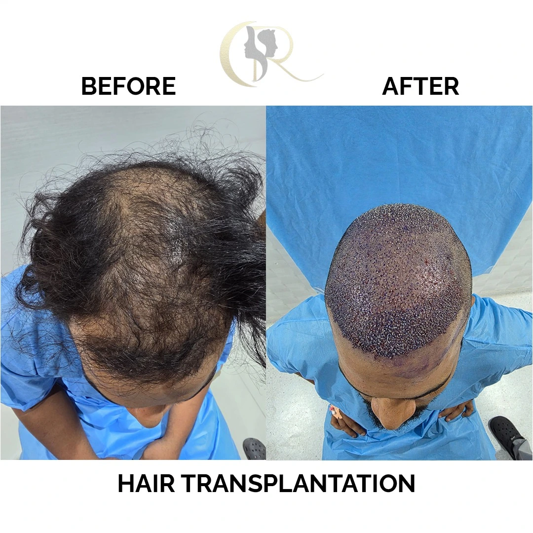 Hair transplant result showing graft density 10 days after surgery at Cosmo Radiance Hyderabad India Hair transplant result showing graft density 10 days after surgery at Cosmo Radiance Hyderabad India