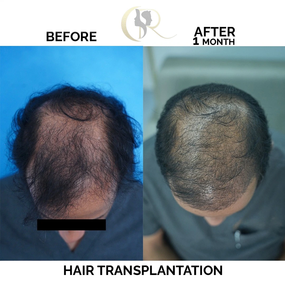 Crown area hair density improvement 2 months after FUE + DHI hair transplant at Cosmo Radiance Hyderabad India Crown area hair density improvement 2 months after FUE + DHI hair transplant at Cosmo Radiance Hyderabad India