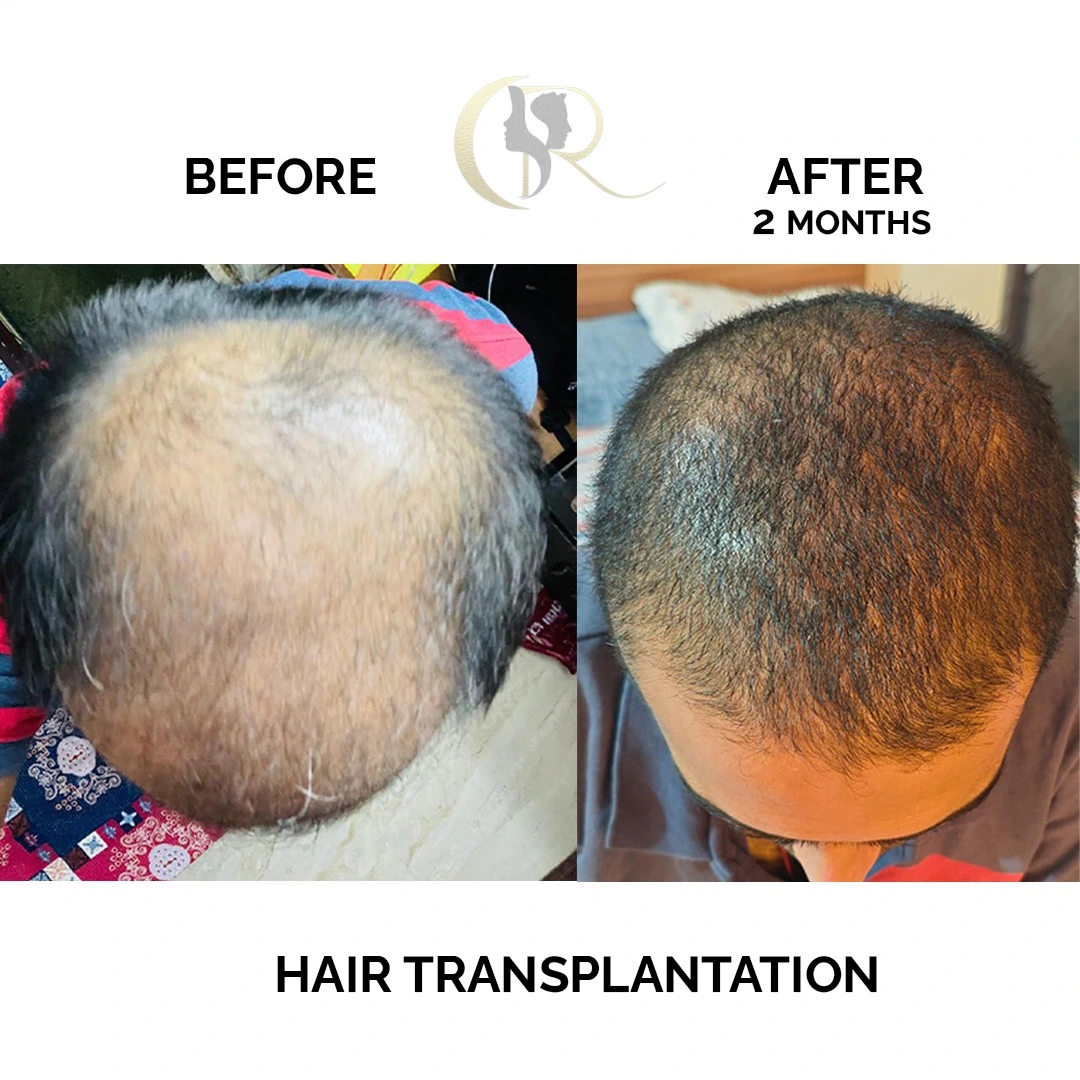 Hair transplant result showing improved hair density 2 months after FUE + DHI procedure at Cosmo Radiance Hyderabad India Hair transplant result showing improved hair density 2 months after FUE + DHI procedure at Cosmo Radiance Hyderabad India