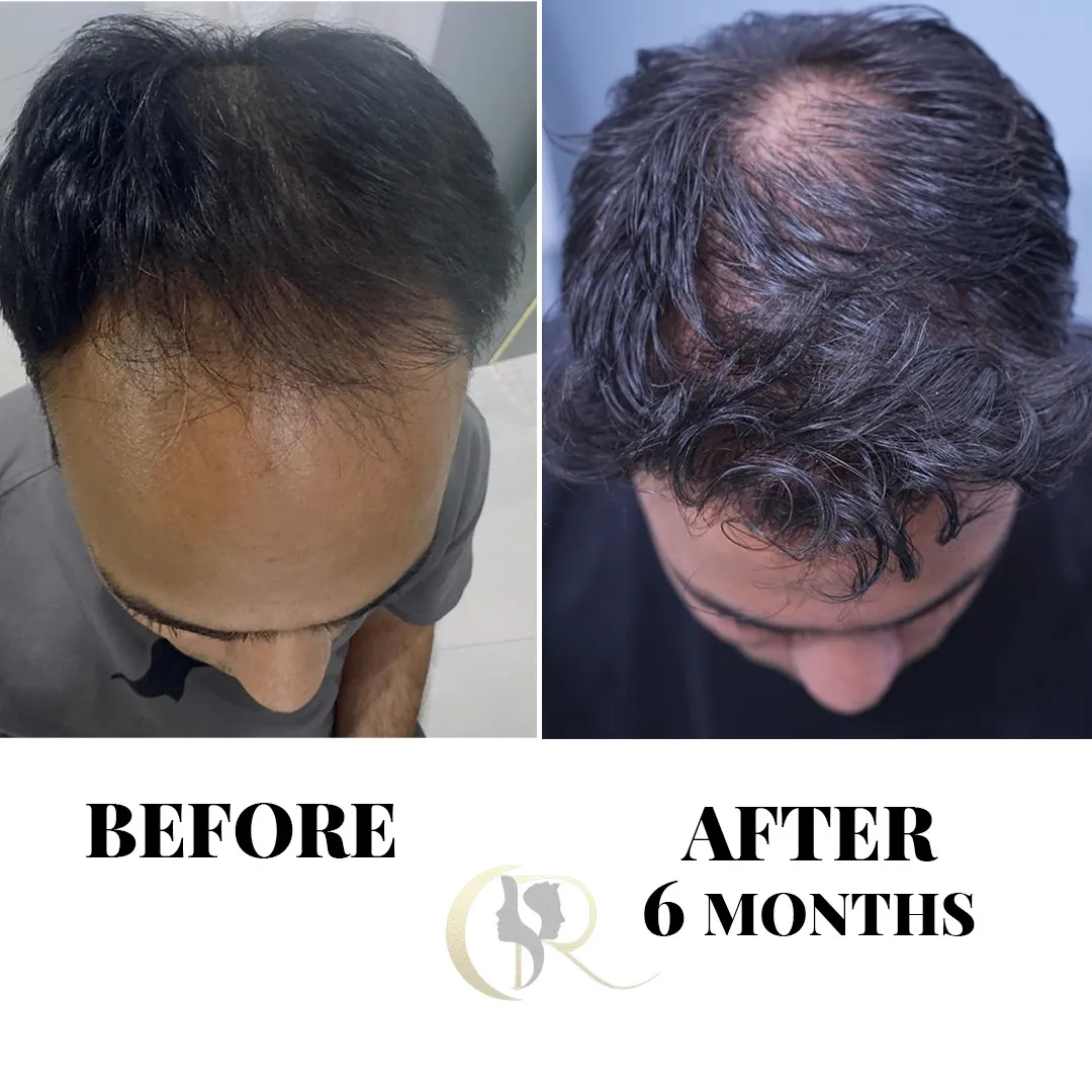 Hairline restoration showing significant hair growth 6 months after FUE + DHI hair transplant at Cosmo Radiance Hyderabad India Hairline restoration showing significant hair growth 6 months after FUE + DHI hair transplant at Cosmo Radiance Hyderabad India