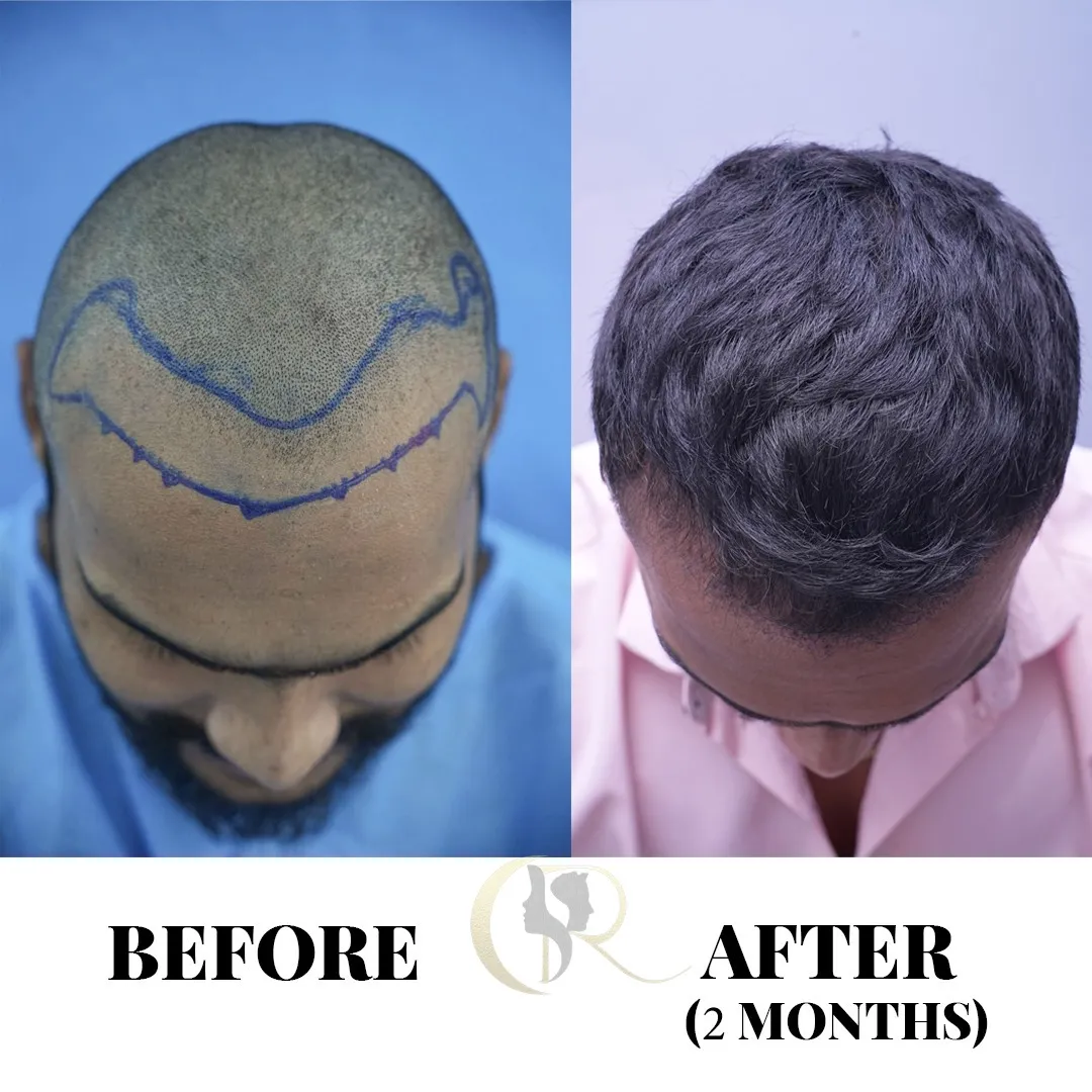 Hair transplant result showing donor and recipient areas on Day 2 months post-surgery at Cosmo Radiance Hyderabad India Hair transplant result showing donor and recipient areas on Day 2 months post-surgery at Cosmo Radiance Hyderabad India