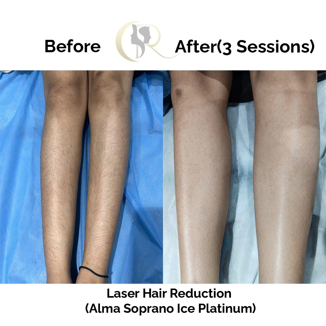 Laser hair removal result on legs after 2 sessions using Alma Soprano Platinum Special Edition at Cosmo Radiance Hyderabad India Laser hair removal result on legs after 2 sessions using Alma Soprano Platinum Special Edition at Cosmo Radiance Hyderabad India
