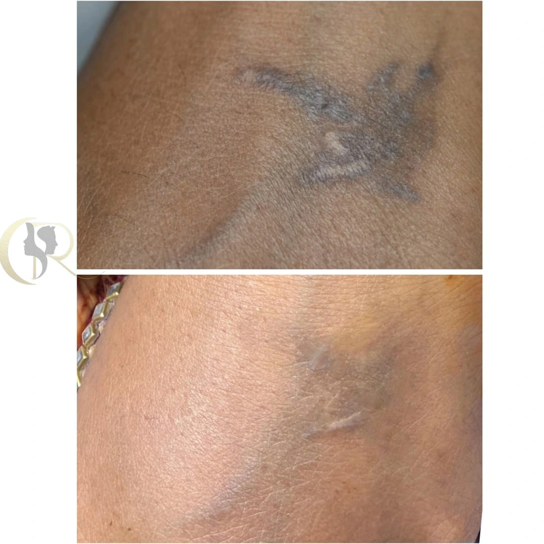 Laser tattoo removal result after 4 sessions using Fractat Fotona Starwalker MAQX and Candela CO2RE at Cosmo Radiance Hyderabad India Laser tattoo removal result after 4 sessions using Fractat Fotona Starwalker MAQX and Candela CO2RE at Cosmo Radiance Hyderabad India