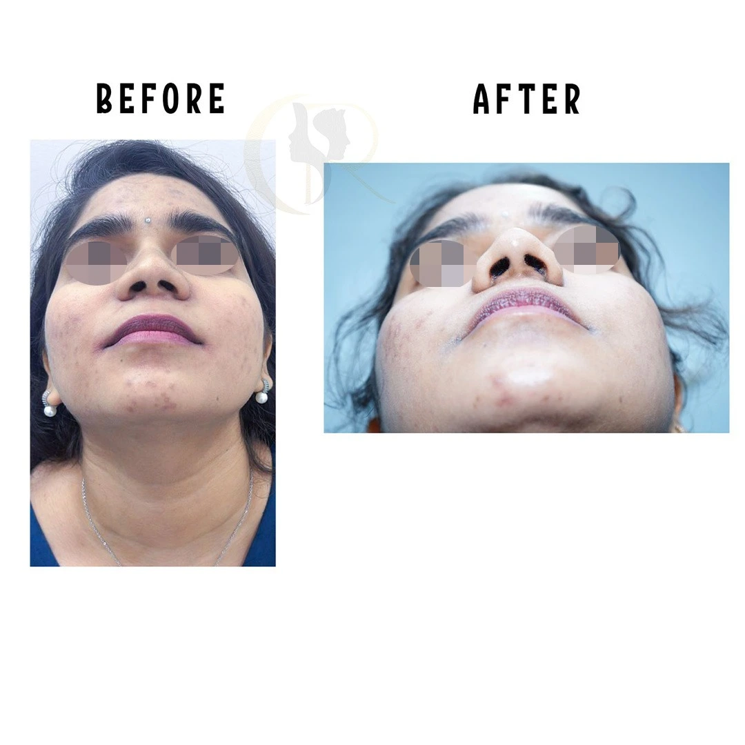 Non-surgical rhinoplasty result showing improved nasal contour at Cosmo Radiance Hyderabad India Non-surgical rhinoplasty result showing improved nasal contour at Cosmo Radiance Hyderabad India