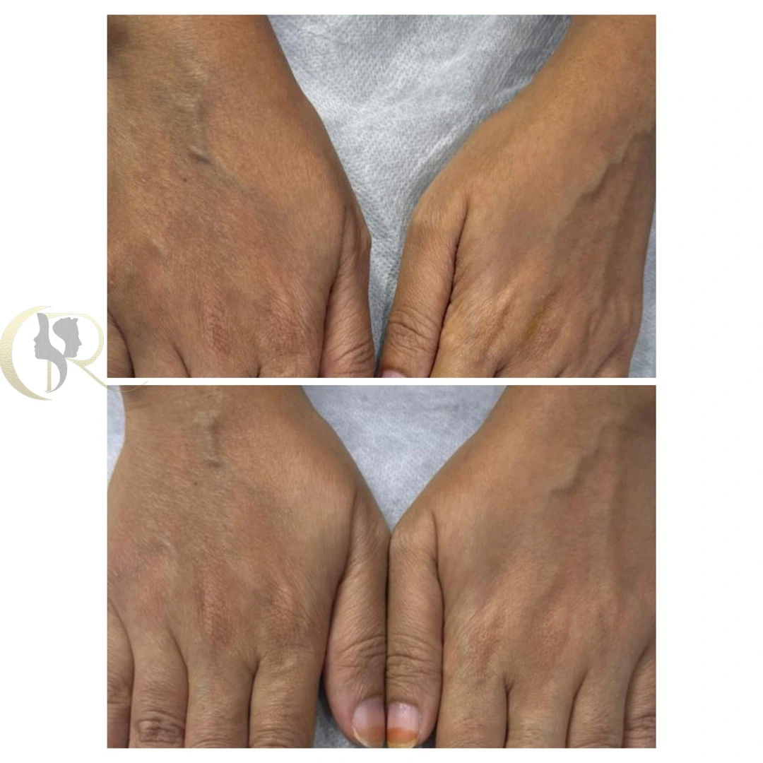 Hand rejuvenation using PDRN treatment showing skin texture improvement after 10 days at Cosmo Radiance Hyderabad India Hand rejuvenation using PDRN treatment showing skin texture improvement after 10 days at Cosmo Radiance Hyderabad India