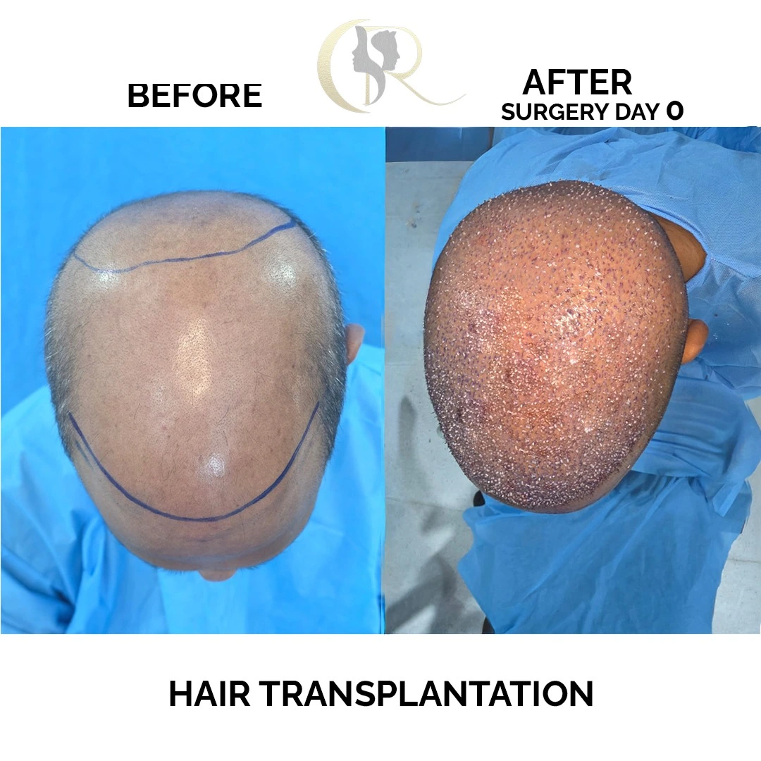 Hair transplant immediate post-op day 0 showing donor and recipient areas after FUE procedure at Cosmo Radiance Hyderabad India Hair transplant immediate post-op day 0 showing donor and recipient areas after FUE procedure at Cosmo Radiance Hyderabad India