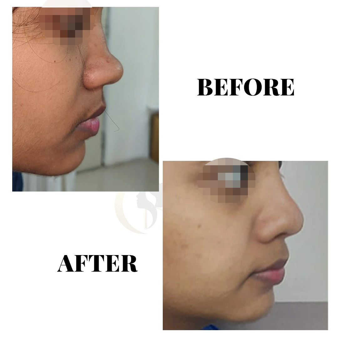 Nasal tip refinement and nostril symmetry basal view result at Cosmo Radiance Hyderabad India Nasal tip refinement and nostril symmetry basal view result at Cosmo Radiance Hyderabad India