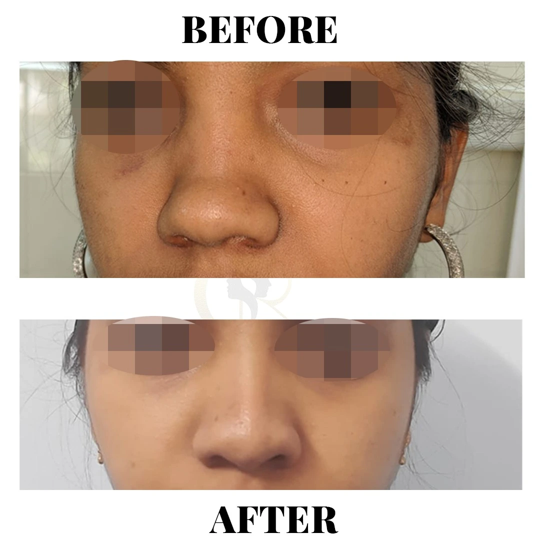 Rhinoplasty side profile result showing nasal bridge correction at Cosmo Radiance Hyderabad India Rhinoplasty side profile result showing nasal bridge correction at Cosmo Radiance Hyderabad India