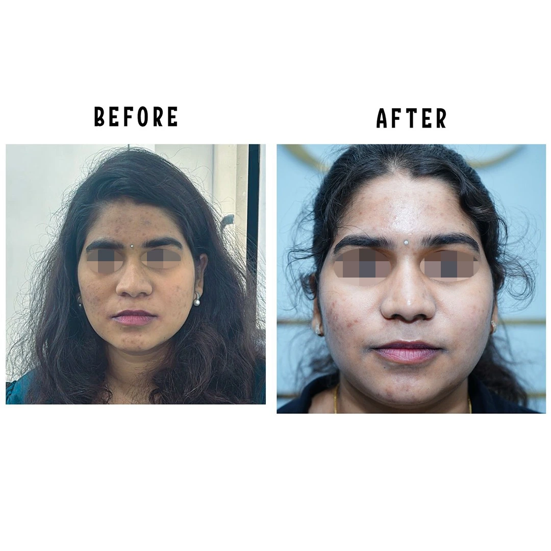 Female rhinoplasty result showing improved nasal symmetry and frontal aesthetics at Cosmo Radiance Hyderabad India Female rhinoplasty result showing improved nasal symmetry and frontal aesthetics at Cosmo Radiance Hyderabad India