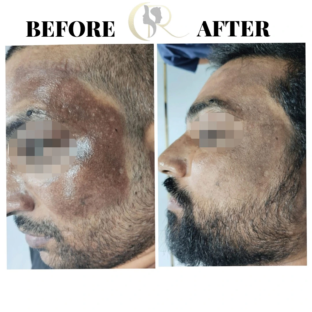 Skin pigmentation treatment using Fotona Starwalker MAQX and Angel Whitening plus chemical peels result after 5 sessions in 3 months at Cosmo Radiance Hyderabad India Skin pigmentation treatment using Fotona Starwalker MAQX and Angel Whitening plus chemical peels result after 5 sessions in 3 months at Cosmo Radiance Hyderabad India
