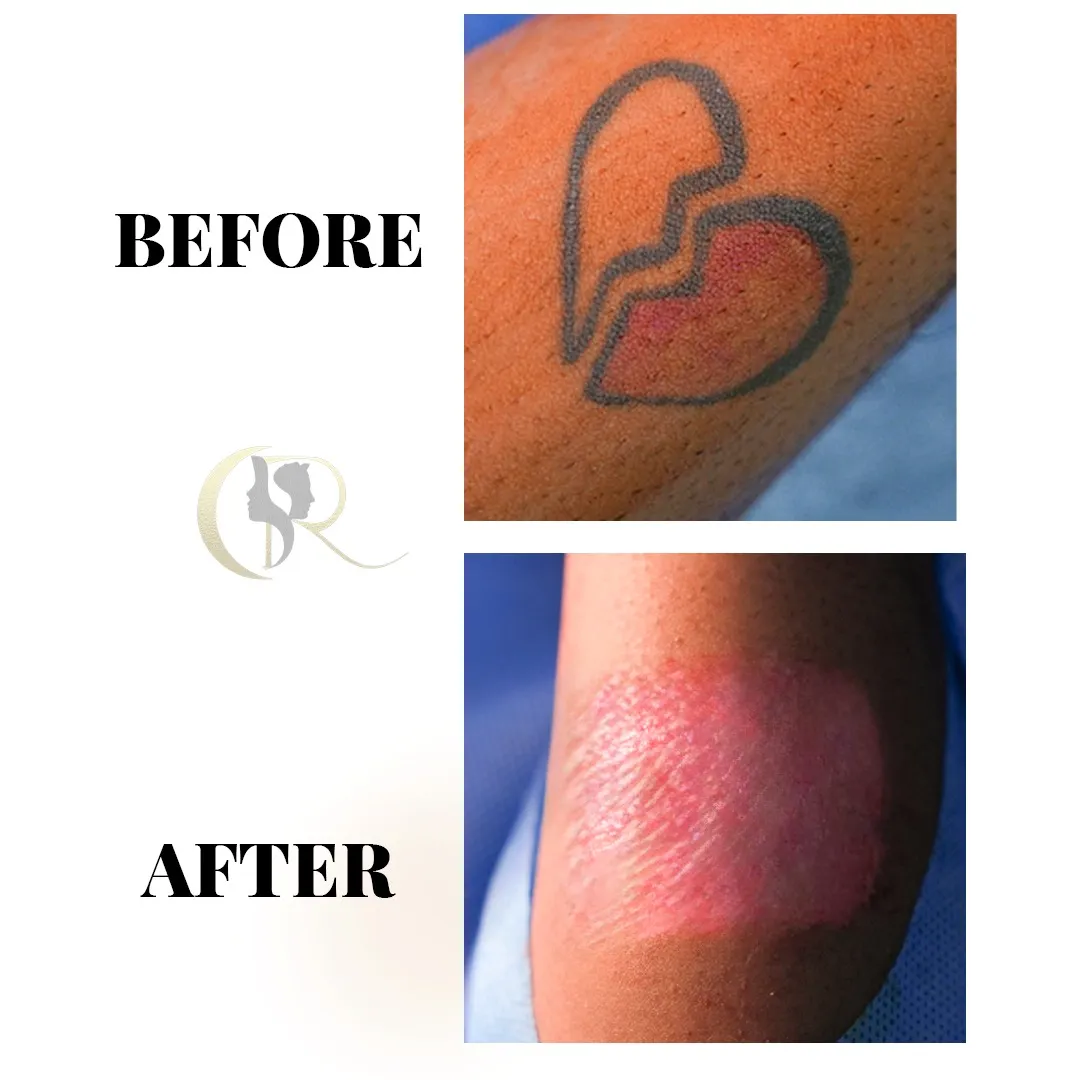 Single session ablative laser tattoo removal result on shoulder showing immediate clearance at Cosmo Radiance Hyderabad India Single session ablative laser tattoo removal result on shoulder showing immediate clearance at Cosmo Radiance Hyderabad India