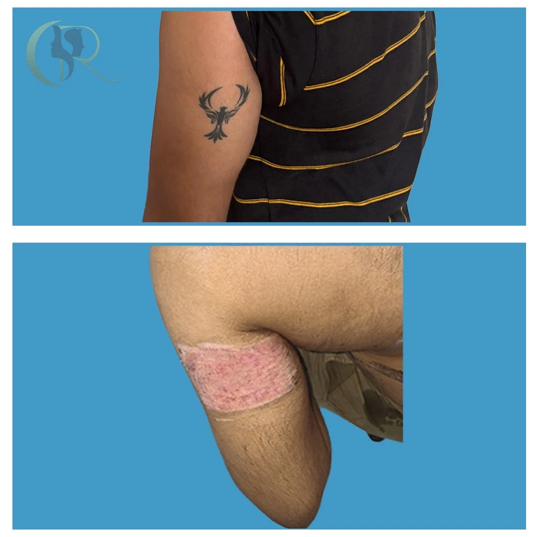 Tattoo removal single session ablative resurfacing result using Candela CO2RE and Fotona Starwalker MAQX Fractat surgical technique at Cosmo Radiance Hyderabad India Tattoo removal single session ablative resurfacing result using Candela CO2RE and Fotona Starwalker MAQX Fractat surgical technique at Cosmo Radiance Hyderabad India