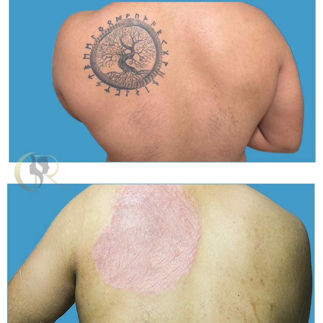 Tattoo removal single session ablative resurfacing result for emergency removal at Cosmo Radiance Hyderabad India Tattoo removal single session ablative resurfacing result for emergency removal at Cosmo Radiance Hyderabad India
