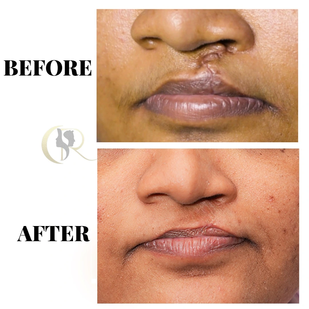 Cleft lip scar revision result after 5 sessions of integrated CO2 laser and ILS 5-FU treatment at Cosmo Radiance Hyderabad India Cleft lip scar revision result after 5 sessions of integrated CO2 laser and ILS 5-FU treatment at Cosmo Radiance Hyderabad India