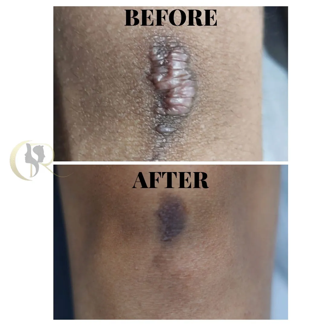 Keloid treatment result showing significant flattening and scar reduction after 5 sessions at Cosmo Radiance Hyderabad India Keloid treatment result showing significant flattening and scar reduction after 5 sessions at Cosmo Radiance Hyderabad India