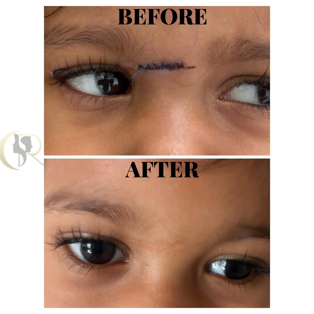 Pediatric facial laceration repair showing soft tissue healing and minimal scarring at Cosmo Radiance Hyderabad India Pediatric facial laceration repair showing soft tissue healing and minimal scarring at Cosmo Radiance Hyderabad India