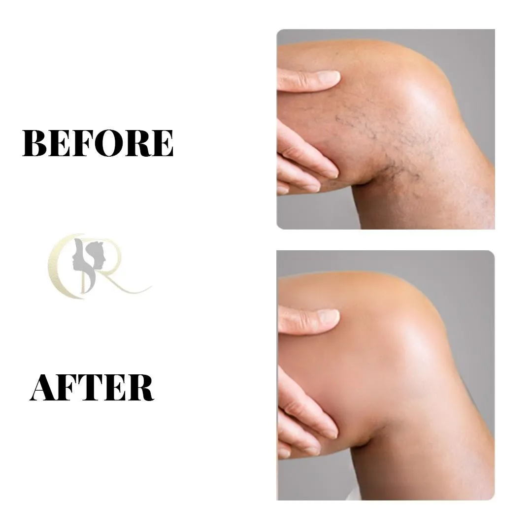 Advanced Varicose Veins Treatment in Hyderabad | Laser Surgery & Sclerotherapy Advanced Varicose Veins Treatment in Hyderabad | Laser Surgery & Sclerotherapy