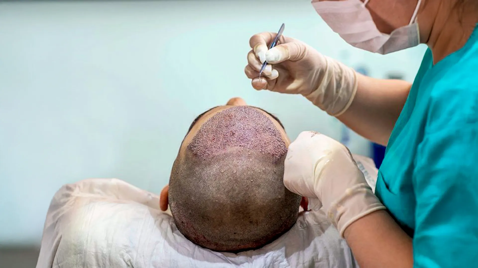 Dhi Direct Hair Implantation Cosmoradiance Hyderabad India