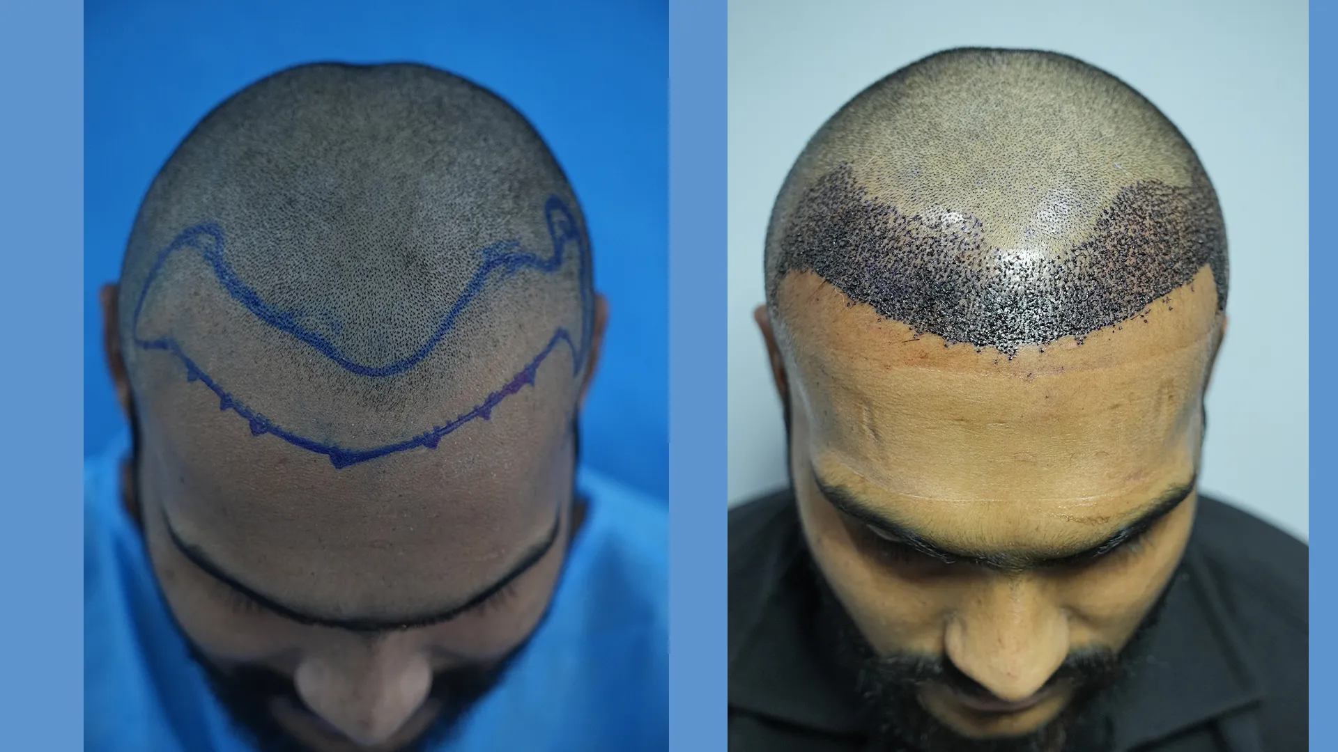 Fue Hair Transplant Plastic Surgery Nmc Guidelines At Cosmoradiance Hyderabad India
