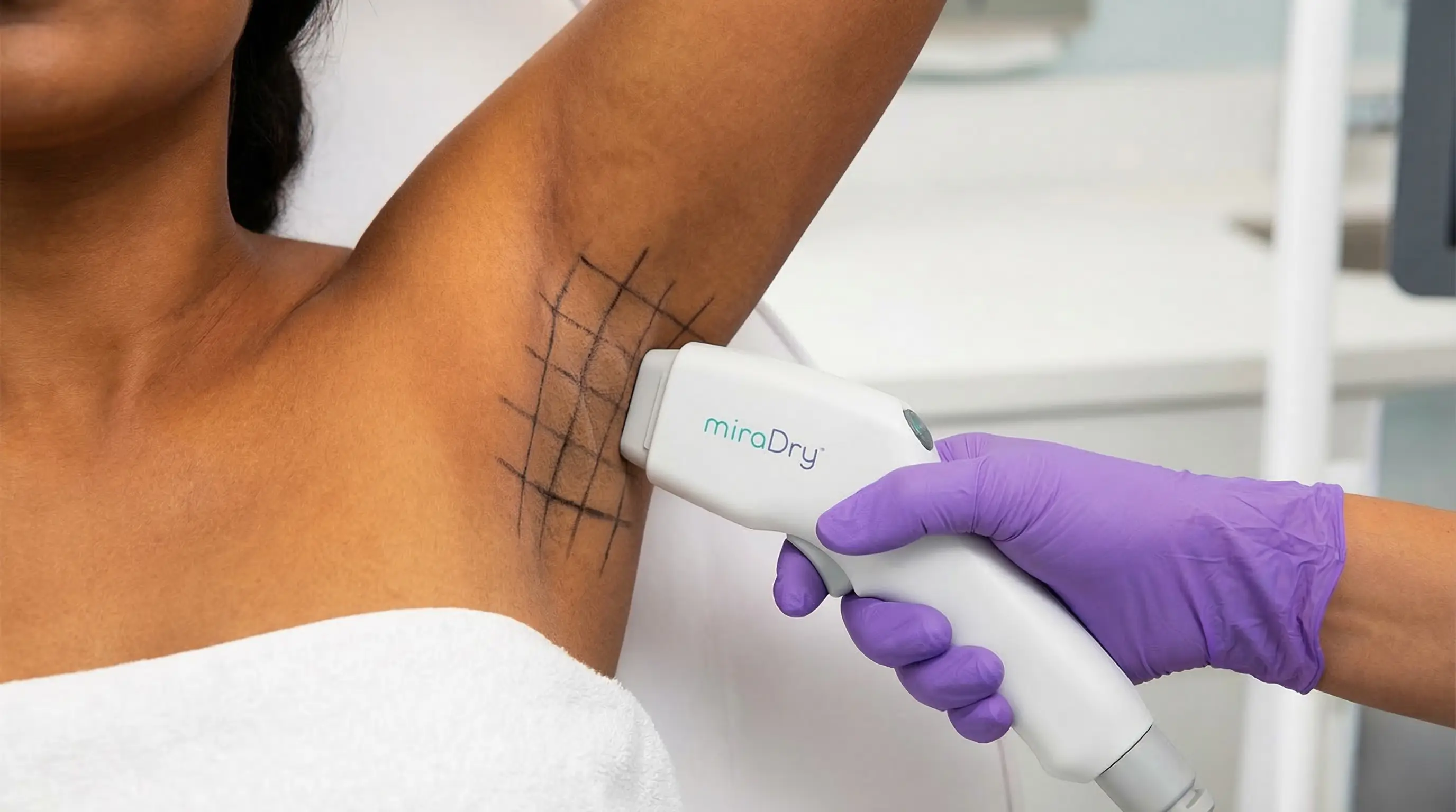 Hyperhidrosis Sweat Reduction At Cosmoradiance