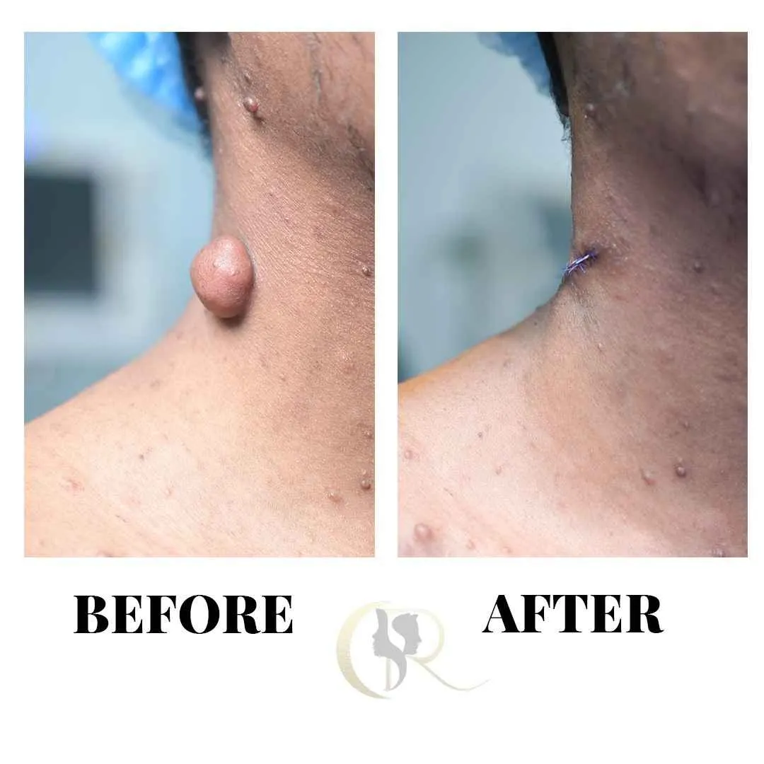 Advanced Neurofibromatosis Treatment in Hyderabad | Laser & Surgery Advanced Neurofibromatosis Treatment in Hyderabad | Laser & Surgery