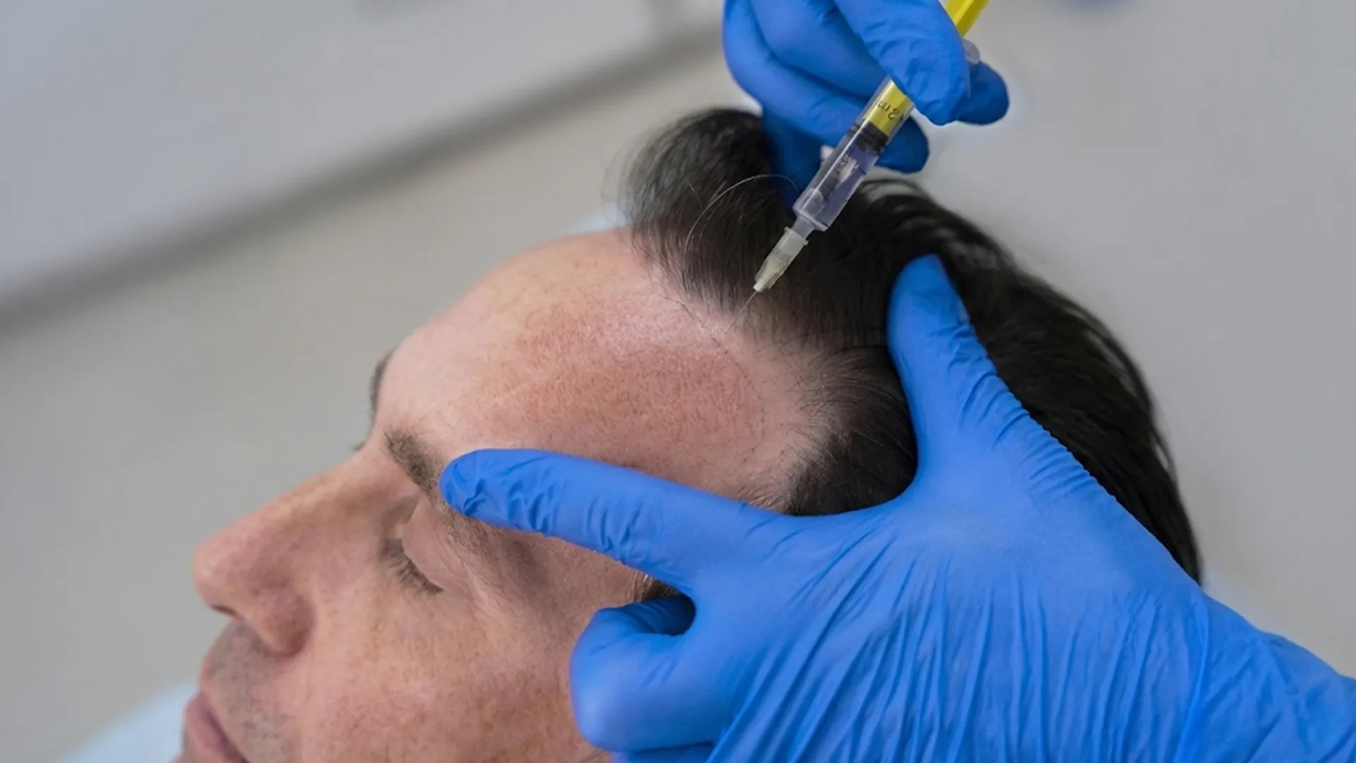 Shi Hair Transplant Cosmoradiance Hyderabad India