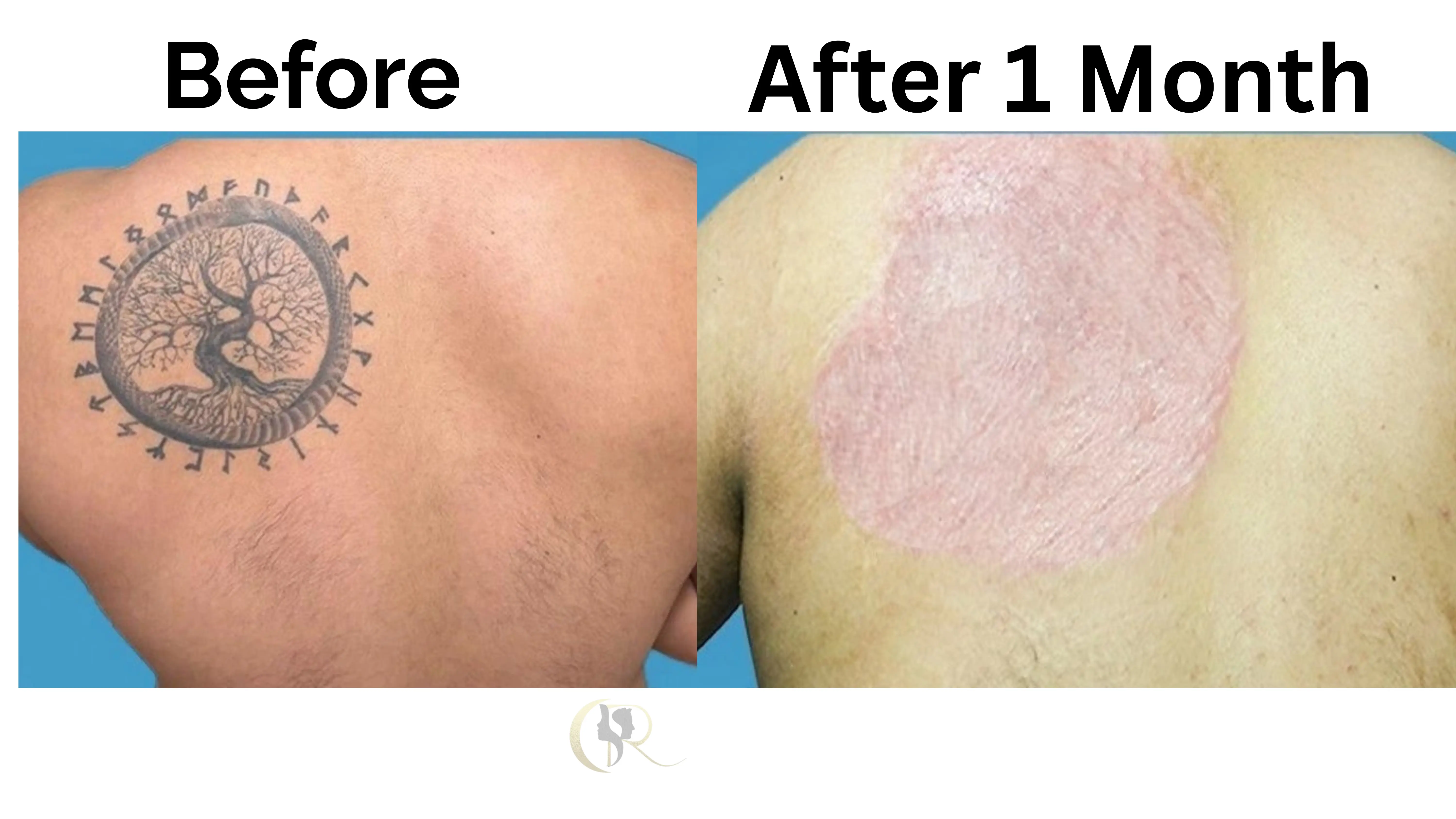 Surgical Tattoo Removal