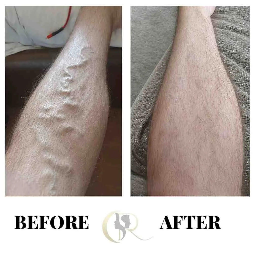 Advanced Varicose Veins Treatment in Hyderabad | Laser Surgery & Sclerotherapy Advanced Varicose Veins Treatment in Hyderabad | Laser Surgery & Sclerotherapy